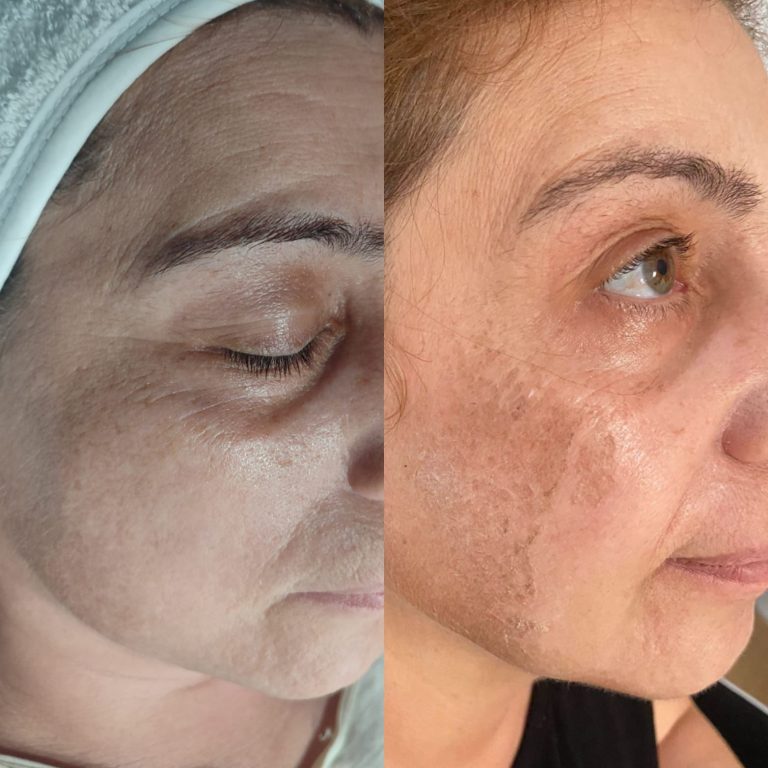 realvip-before-after-ciltbakım