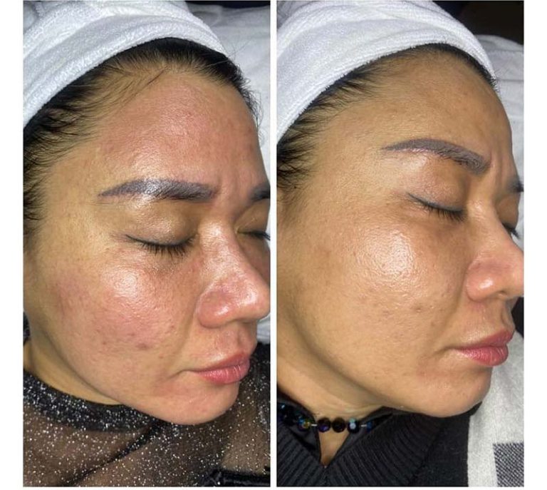 realvip-before-after-ciltbakım