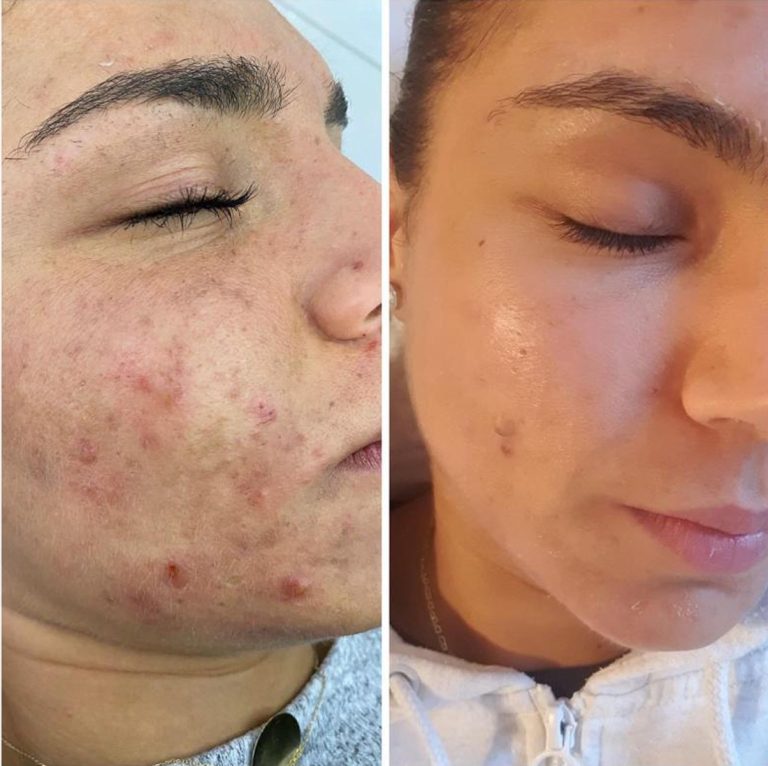 realvip-before-after-ciltbakım3