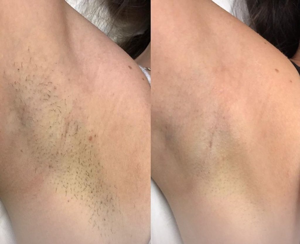 bahçelievler buz lazer