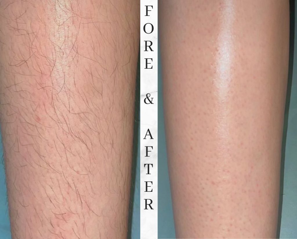 bahçelievler buz lazer