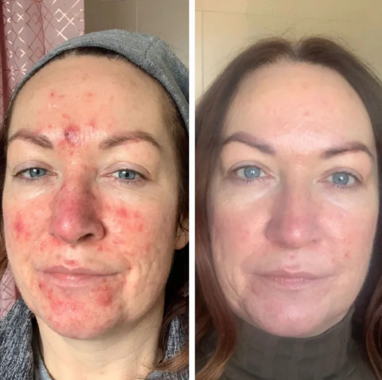 realvip-before-after-ciltbakım2